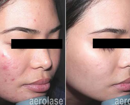 laser acne treatment on asian skin