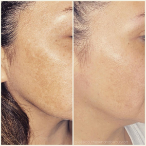 Melasma