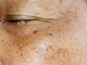 Sun damage freckles and sunspot pigment